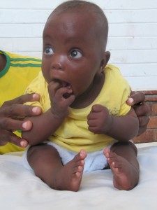 Zimbabwean baby with clubfoot