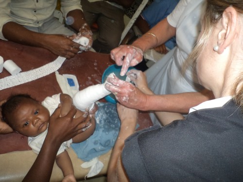 Atypical clubfoot casting, Solomon Islands